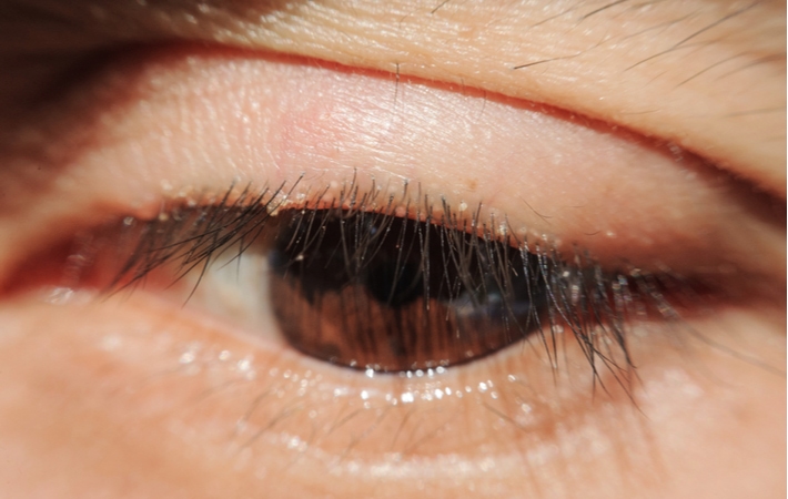A close up of an eye with a swollen, inflamed eyelid, known as blepharitis