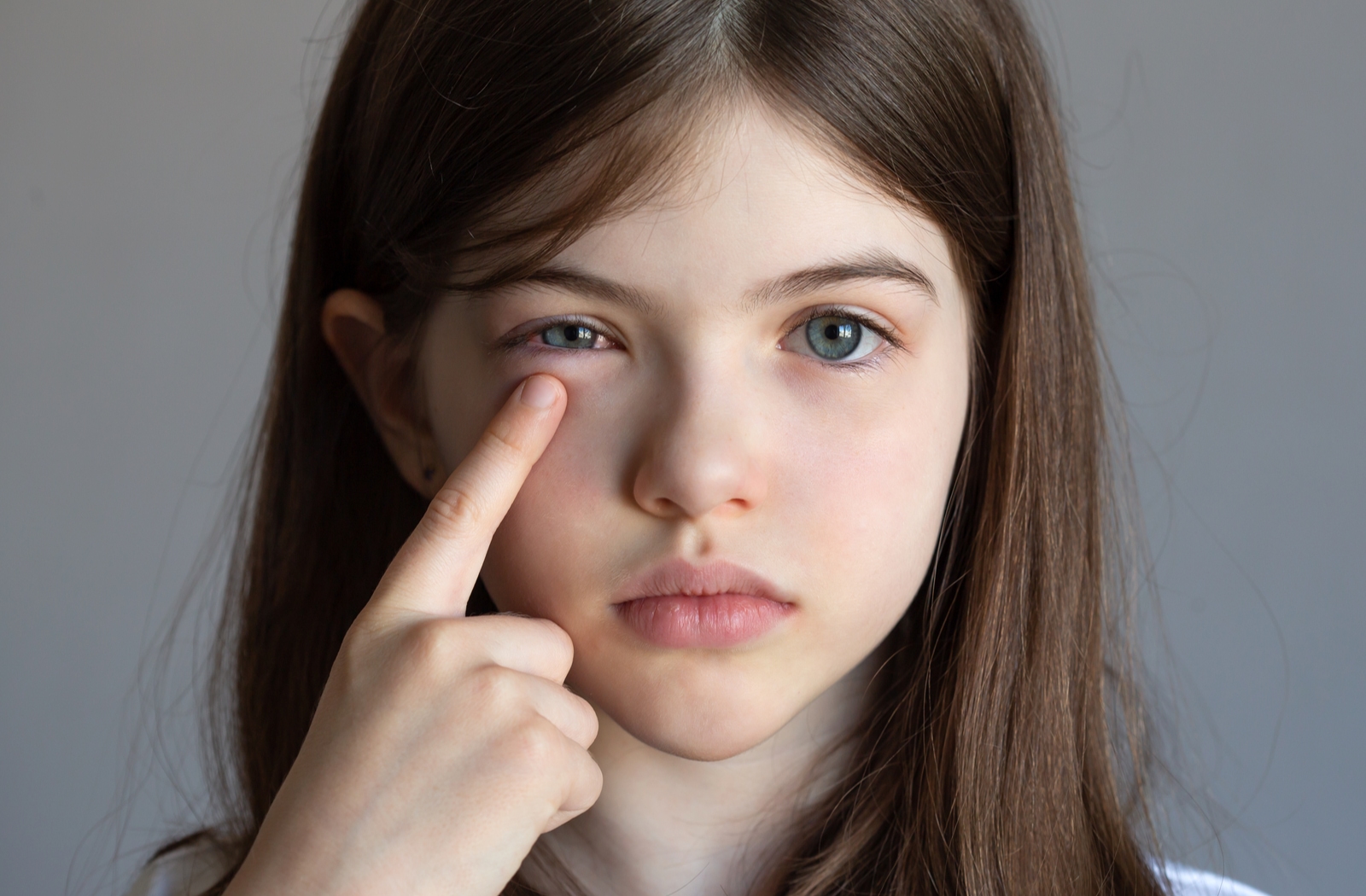 A young girl using her finger to touch just below her swollen, infected right eye