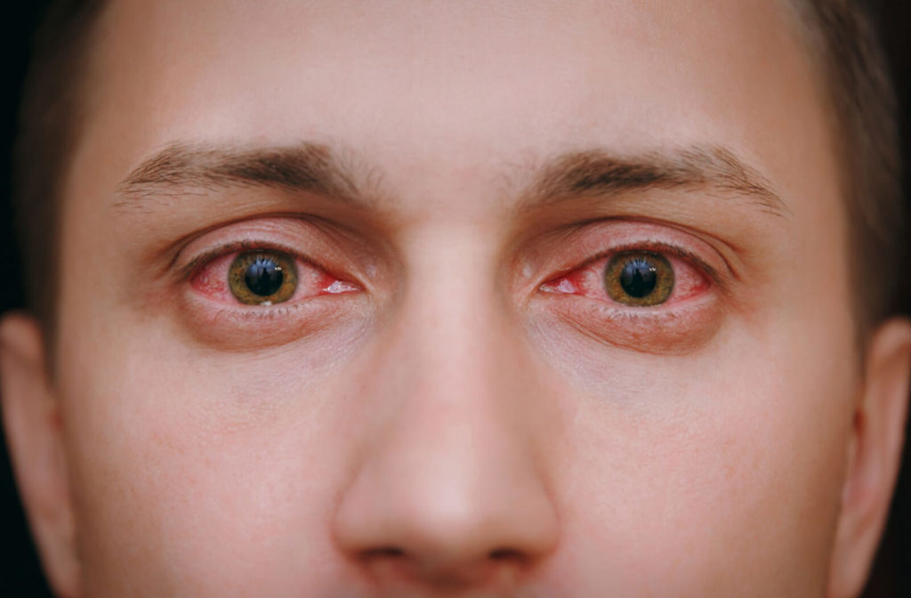 A close-up of a man's eyes that are infected from wearing contacts while swimming.