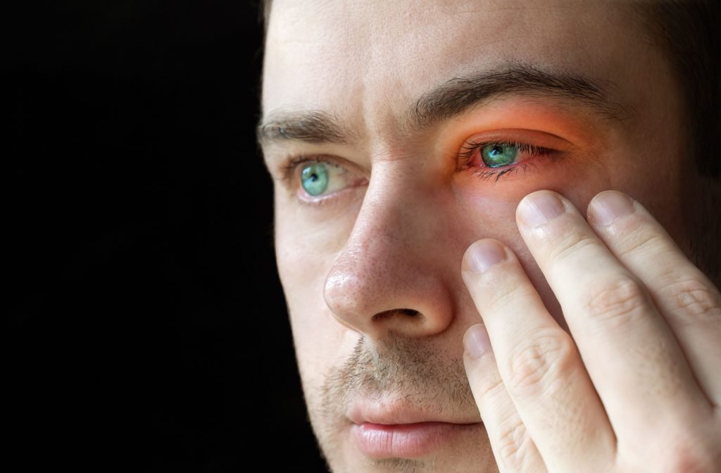 A person gently touches their cheek below their red, inflamed eye.