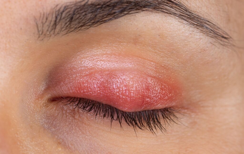 A person closes their eye. They have a large, painful stye on their upper eyelid and their eyelid is red and inflamed.