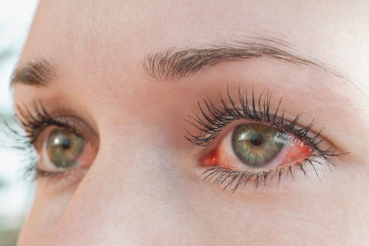Close-up of a person's eyes showing redness and irritation in the corner of the eye, a common symptom of dry eyes from contact lens wear.