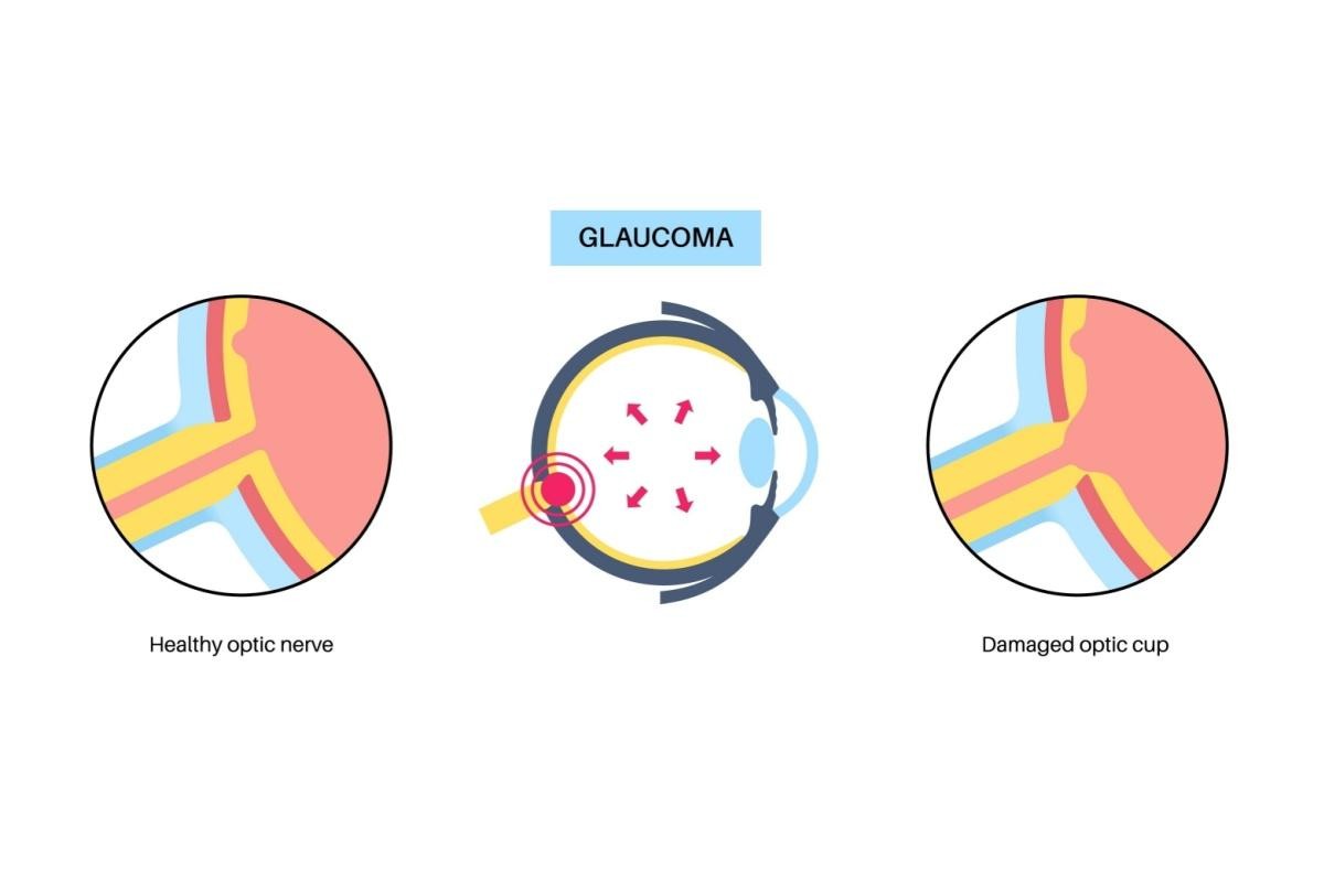 An informative medical illustration explaining glaucoma. The center diagram shows a cross-section of an eye with red arrows indicating high intraocular pressure pushing against the optic nerve at the back. A left inset circle shows a close-up of a healthy optic nerve, while the right inset circle illustrates a damaged optic cup with pronounced cupping caused by glaucoma-related pressure.