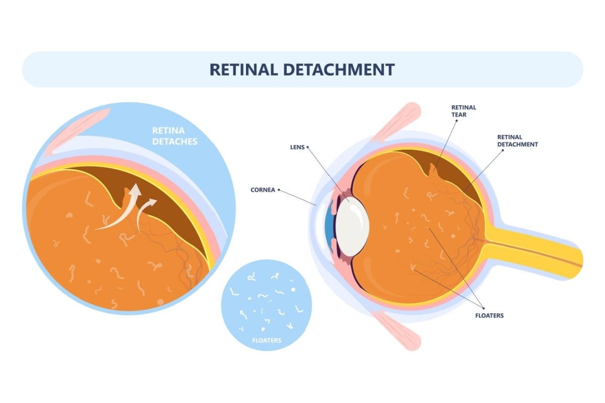 An educational medical illustration of the human eye detailing retinal detachment and floaters. The main diagram shows an eye cross-section with labels for the cornea, lens, a retinal tear, retinal detachment, and floaters in the vitreous humor. Two inset illustrations provide close-up views: one highlights the area where the retina detaches with fluid flowing behind it, and the other shows a simplified visual representation of eye floaters.